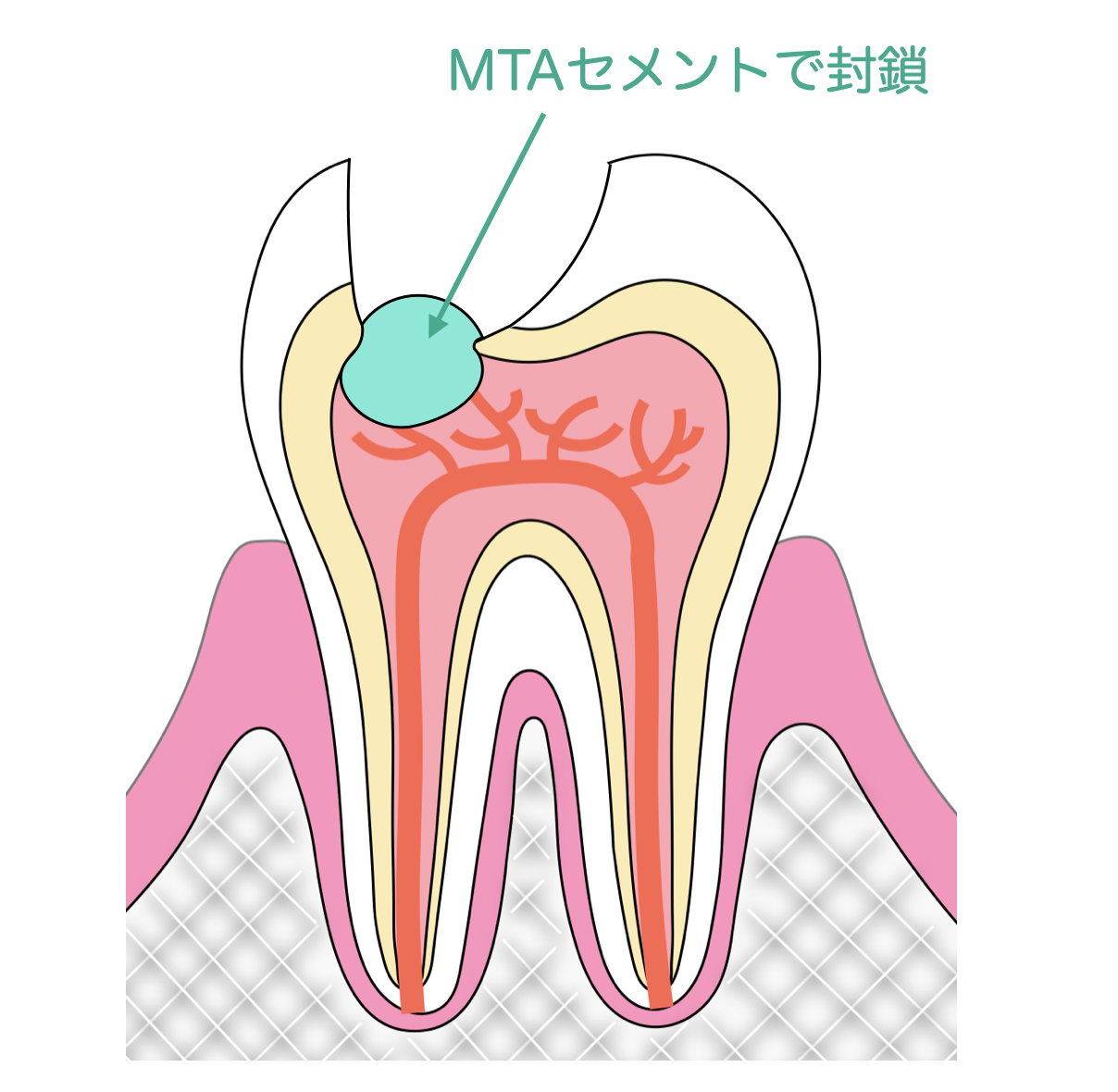 虫歯が深くても神経を抜かない！？