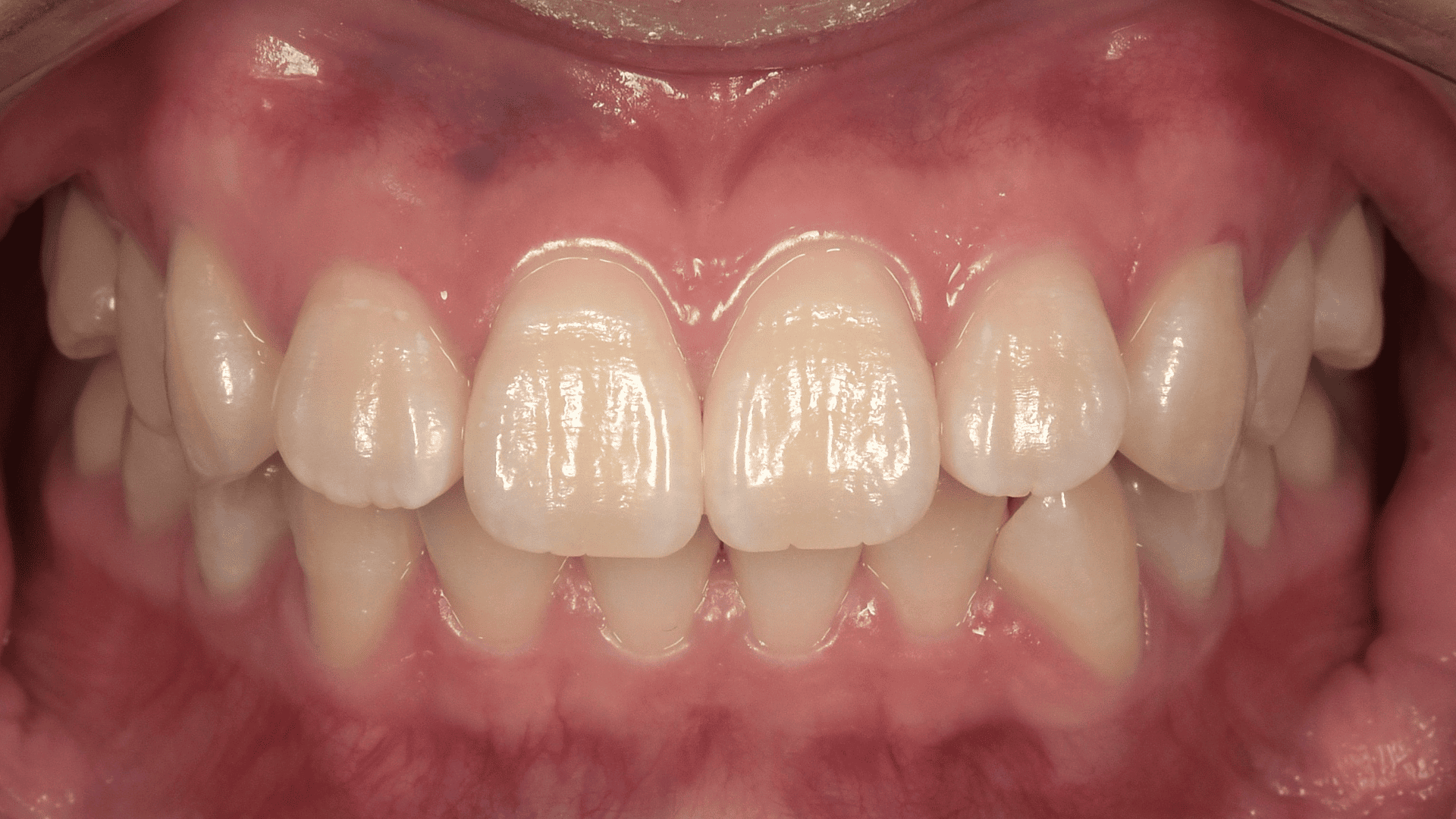 オフィスホワイトニング症例（歯医者さんで行うホワイトニング）