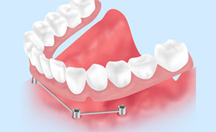 インプラントオーバーデンチャー