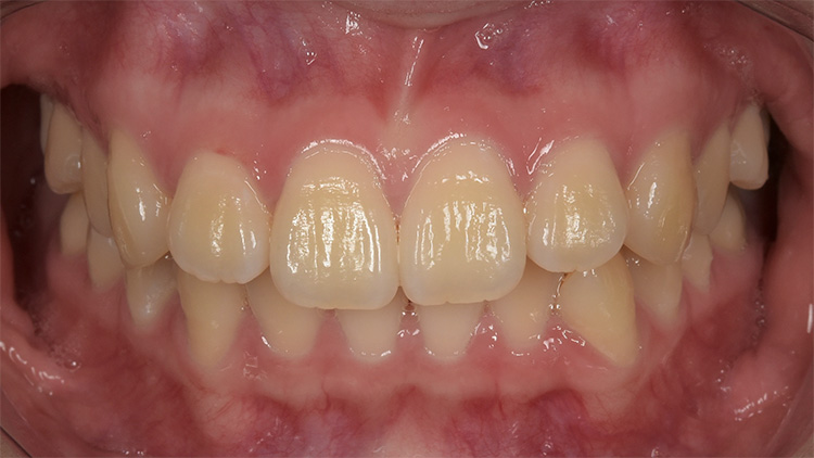 ホワイトニング前