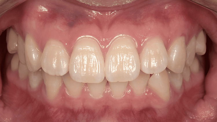 オフィスホワイトニング後