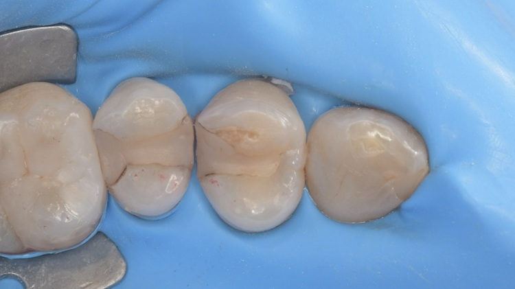 ダイレクトボンディング前