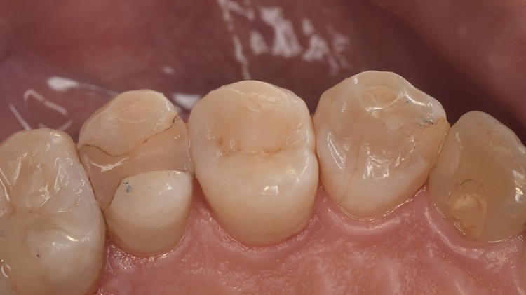 ダイレクトボンディング後