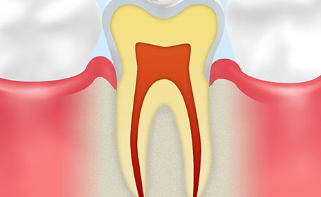 むし歯治療