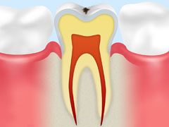 C0：ごく初期のむし歯
