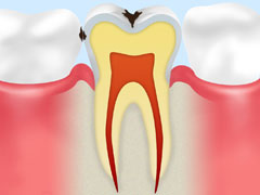 C1:エナメル質のむし歯