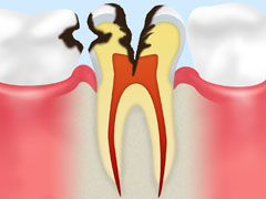 C3:神経に達したむし歯