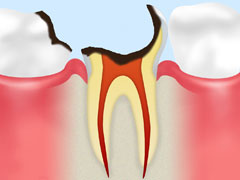 C4:歯根に達したむし歯