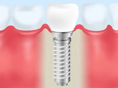 インプラントとブリッジの違い