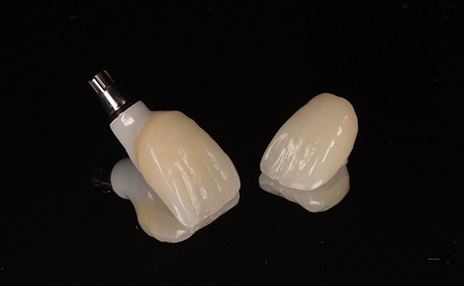 インプラント治療の流れ