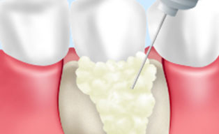 歯周組織再生療法（エムドゲイン）