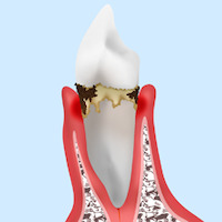 中度の歯周炎